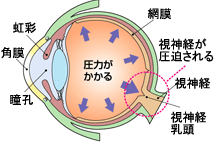 緑内障はどのような病気？