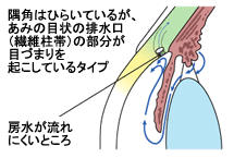 原発開放隅角緑内障