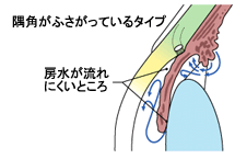 原発閉塞隅角緑内障